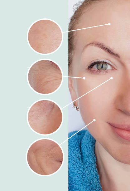 How To Get Rid Of Wrinkles And Fine Lines? How To Get Rid Of Wrinkles And Fine Lines?